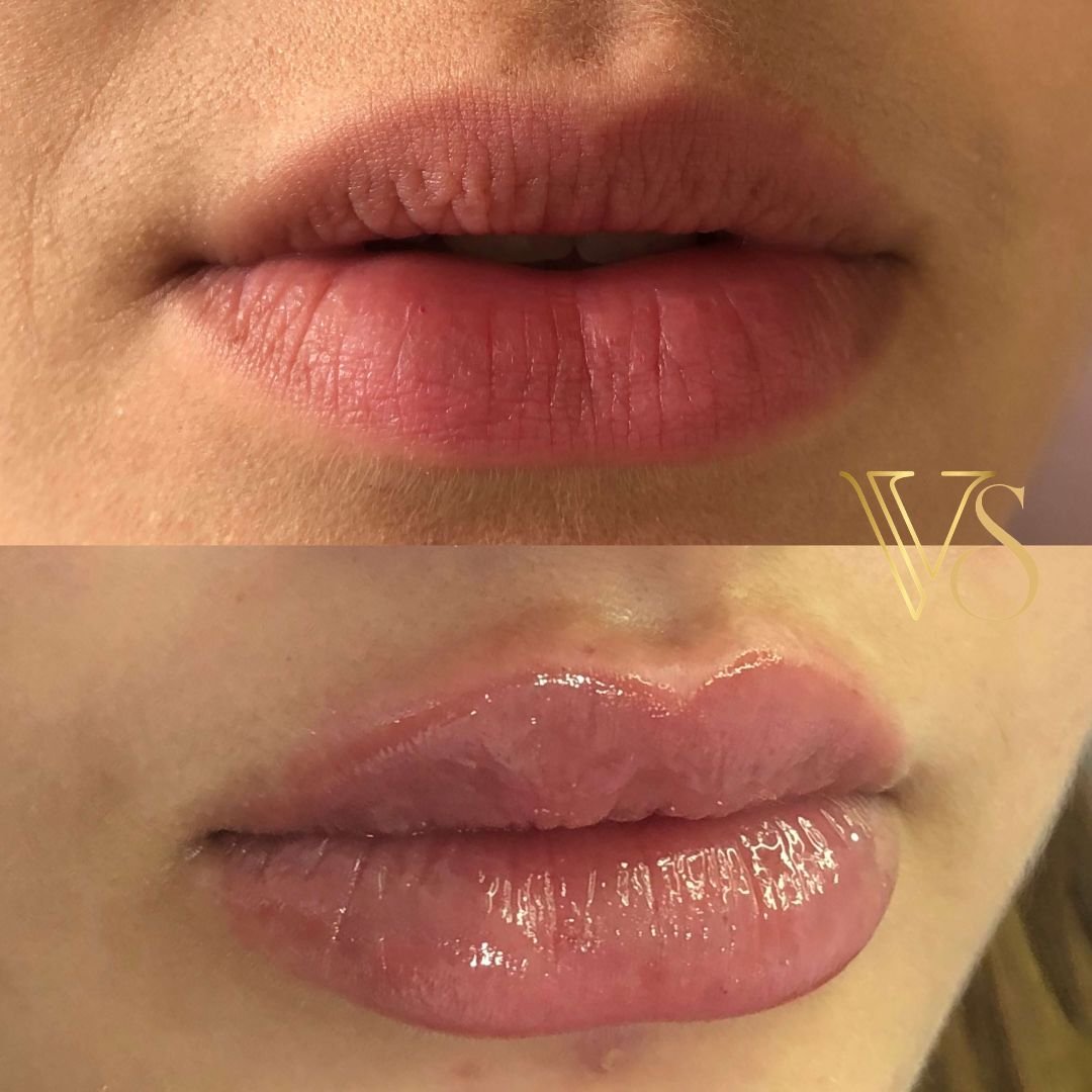 Preenchimento labial em Castro Dra Vanessa Silveira