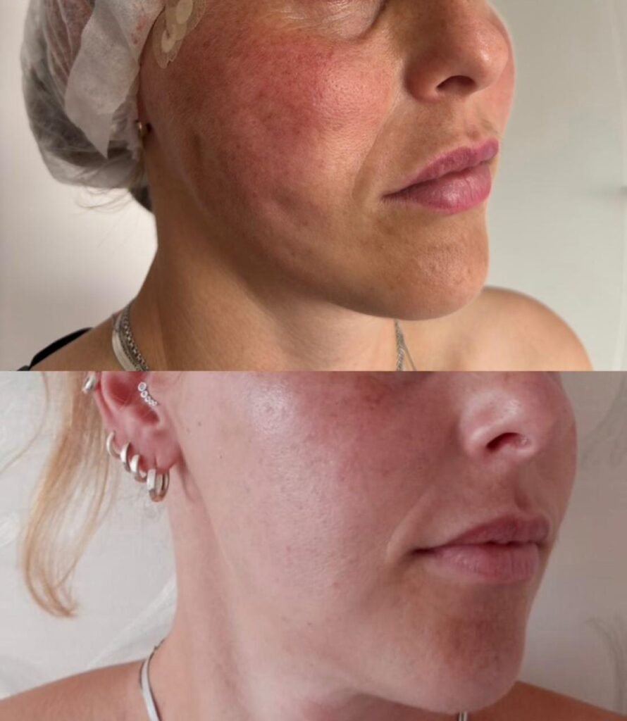 Reações pós lifting facial com fios