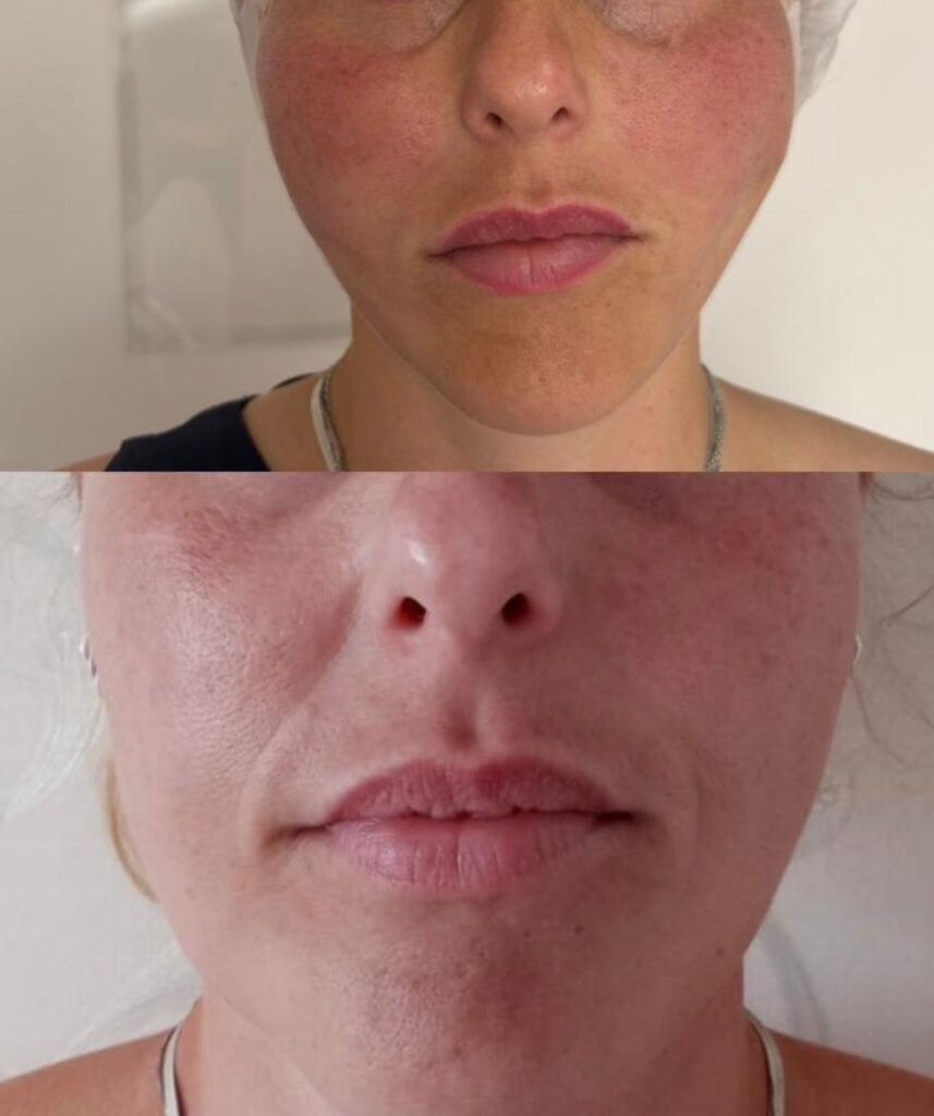 Reações pós lifting facial com fios