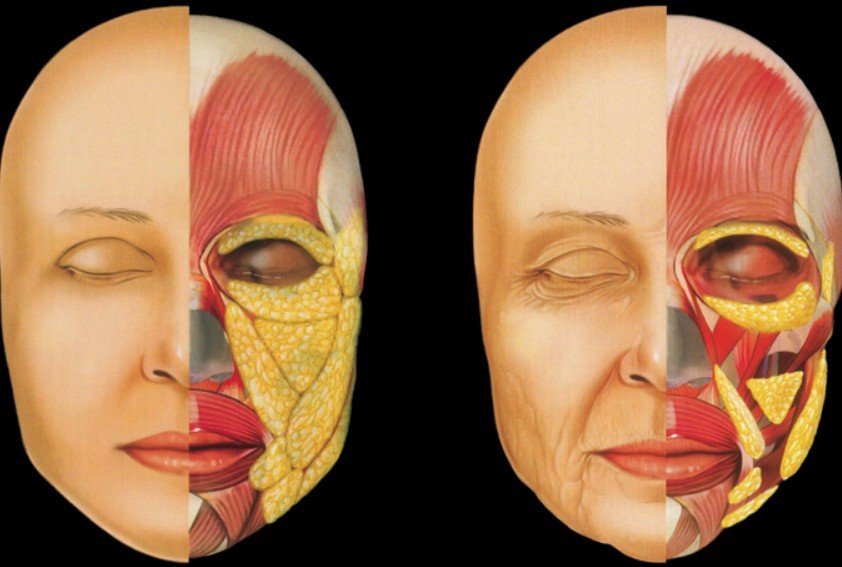 LIFT VS 360 - Tratamento para face pos emagrecimento em Castro - Dra Vanessa Silveira