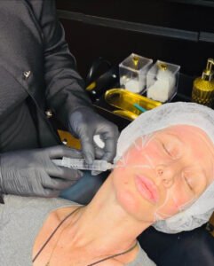 Lifting facial sem cirurgia - Dra Vanessa Silveira em Castro e Ponta Grossa