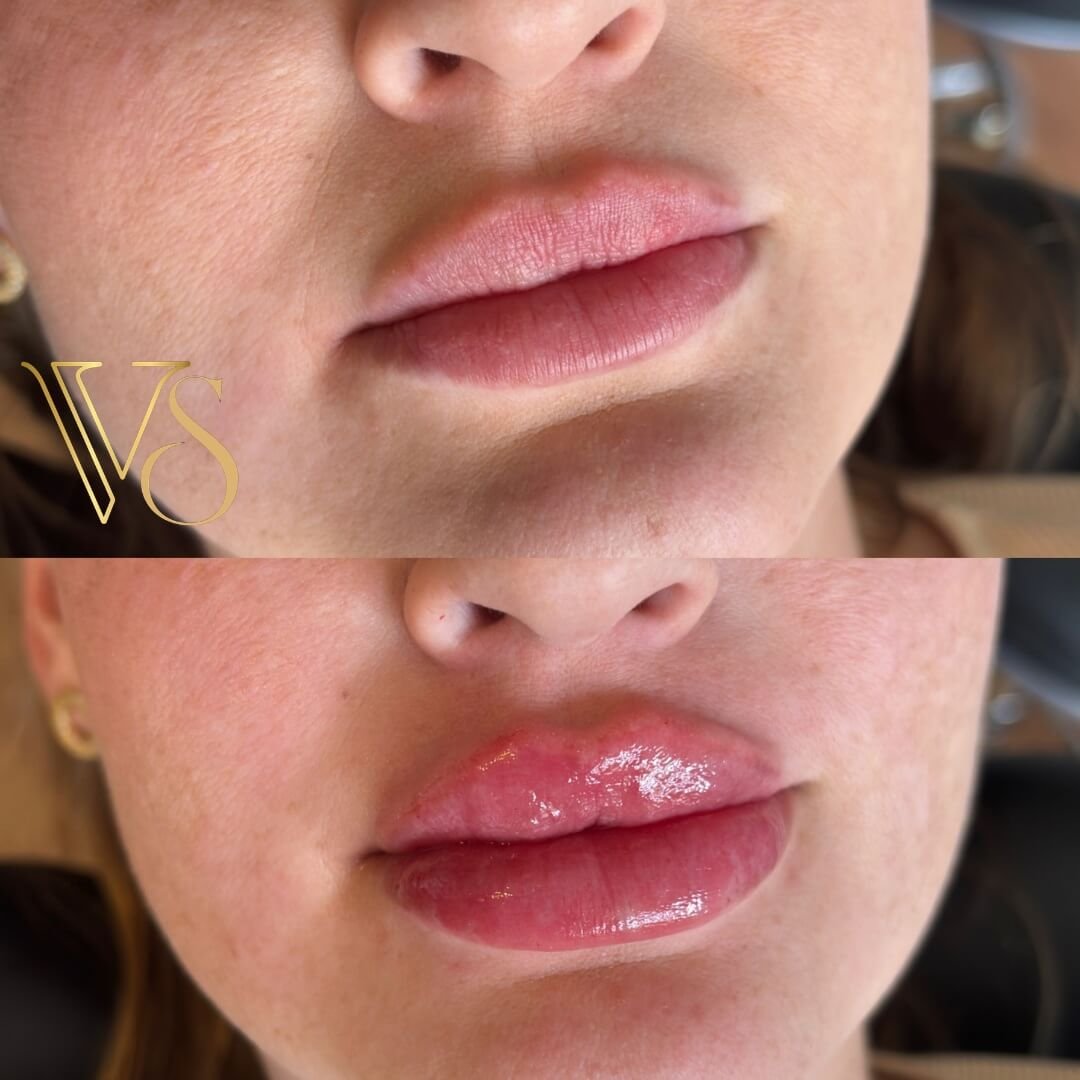 Referencia em preenchimento labial em Castro e Ponta Grossa - Dra Vanessa Silveira