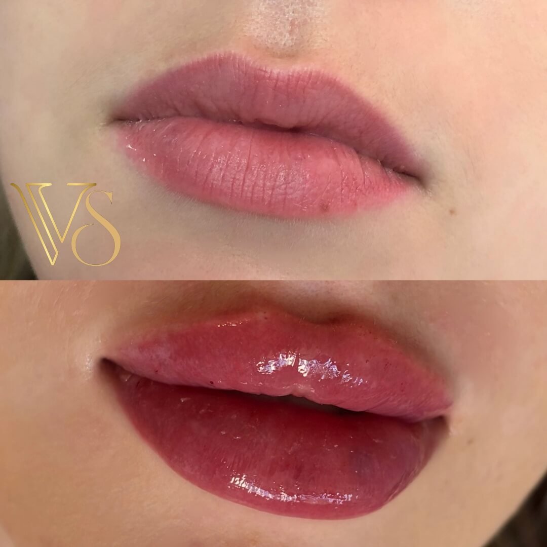 Referencia em preenchimento labial em Castro e Ponta Grossa - Dra Vanessa Silveira