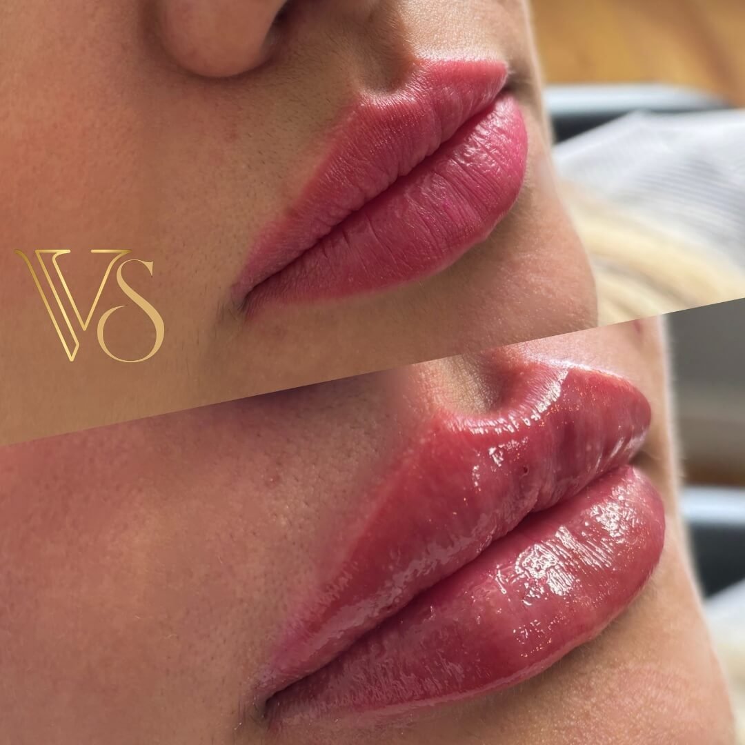 Referencia em arco do cupido bem desenhado - Dra Vanessa Silveira em Castro e Ponta Grossa