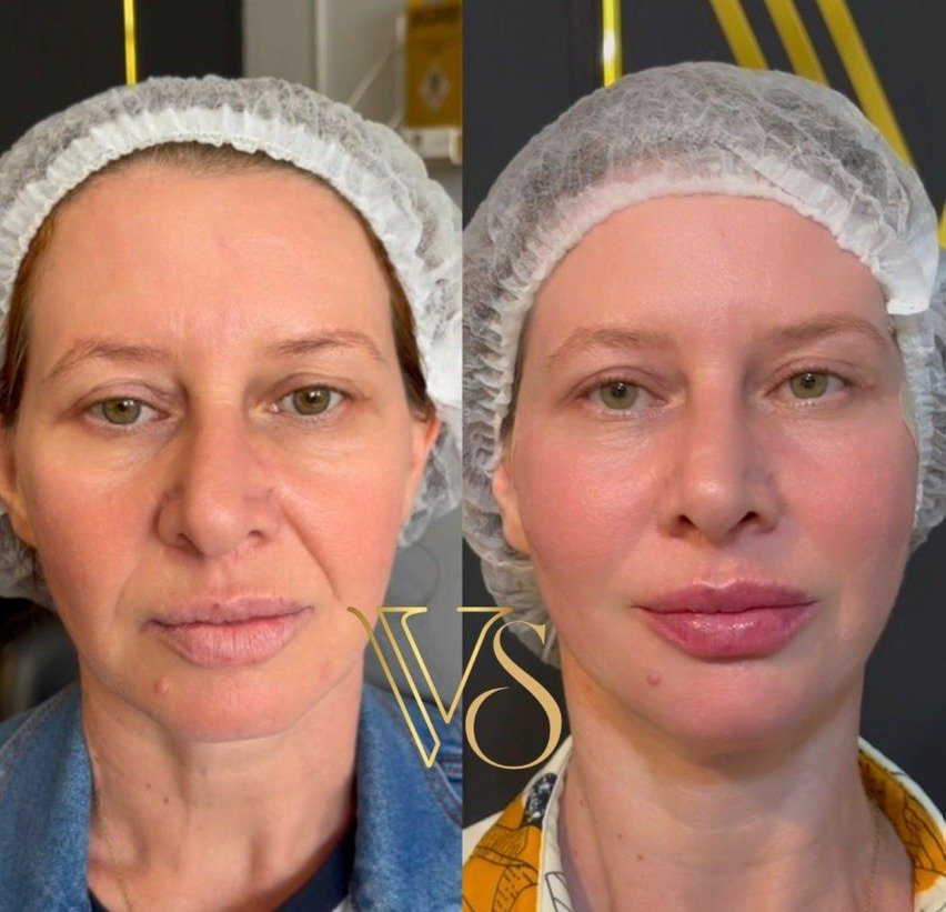 Lifting facial com fios