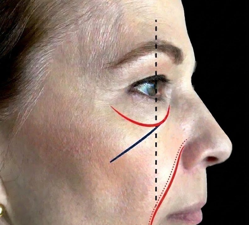 Solução para o bigode chines - Face UP Dra Vanessa Silveira