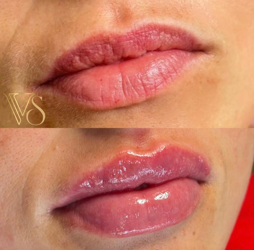 Preenchimento labial em Castro-PR Dra Vanessa Silveira