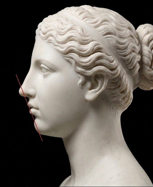 Perfiloplastia em castro pr Dra Vanessa Silveira