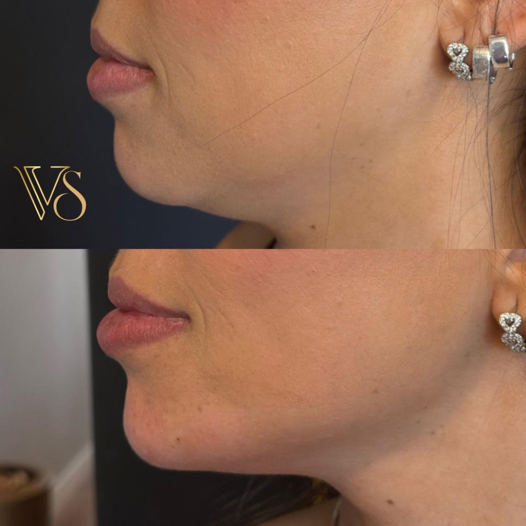 Mentoplastia Dra Vanessa Silveira Castro e Ponta Grossa