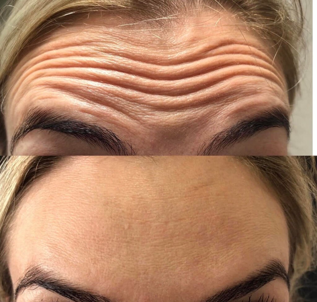 Botox em castro pr Dra Vanessa Silveira